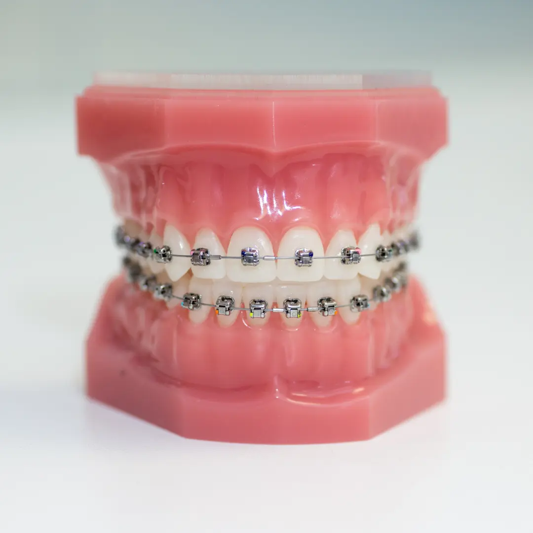 Benefits of lingual braces