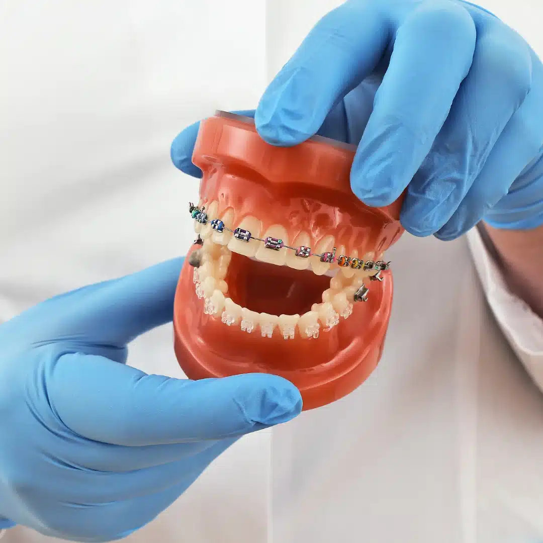 Braces vs lingual braces cost
