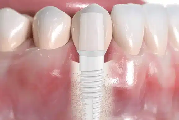 Dental implants new orleans, la