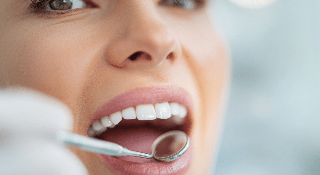 Teeth whitening