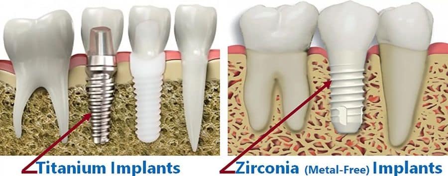 Zirconia metal-free implants